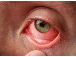 WHAT CAUSESING CONJUNCTIVITIS