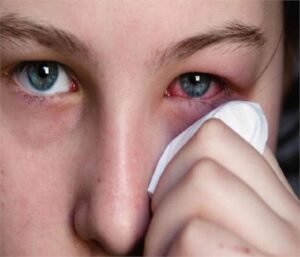 Eye Flu in Kids: Causes Symptoms and Treatment