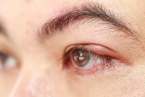 Effective Tips for Reducing Eye Swelling