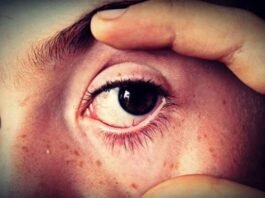 Eye Flu in Kids: Causes Symptoms and Treatment