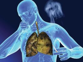 Raising Awareness on World Lung Cancer Day 2023